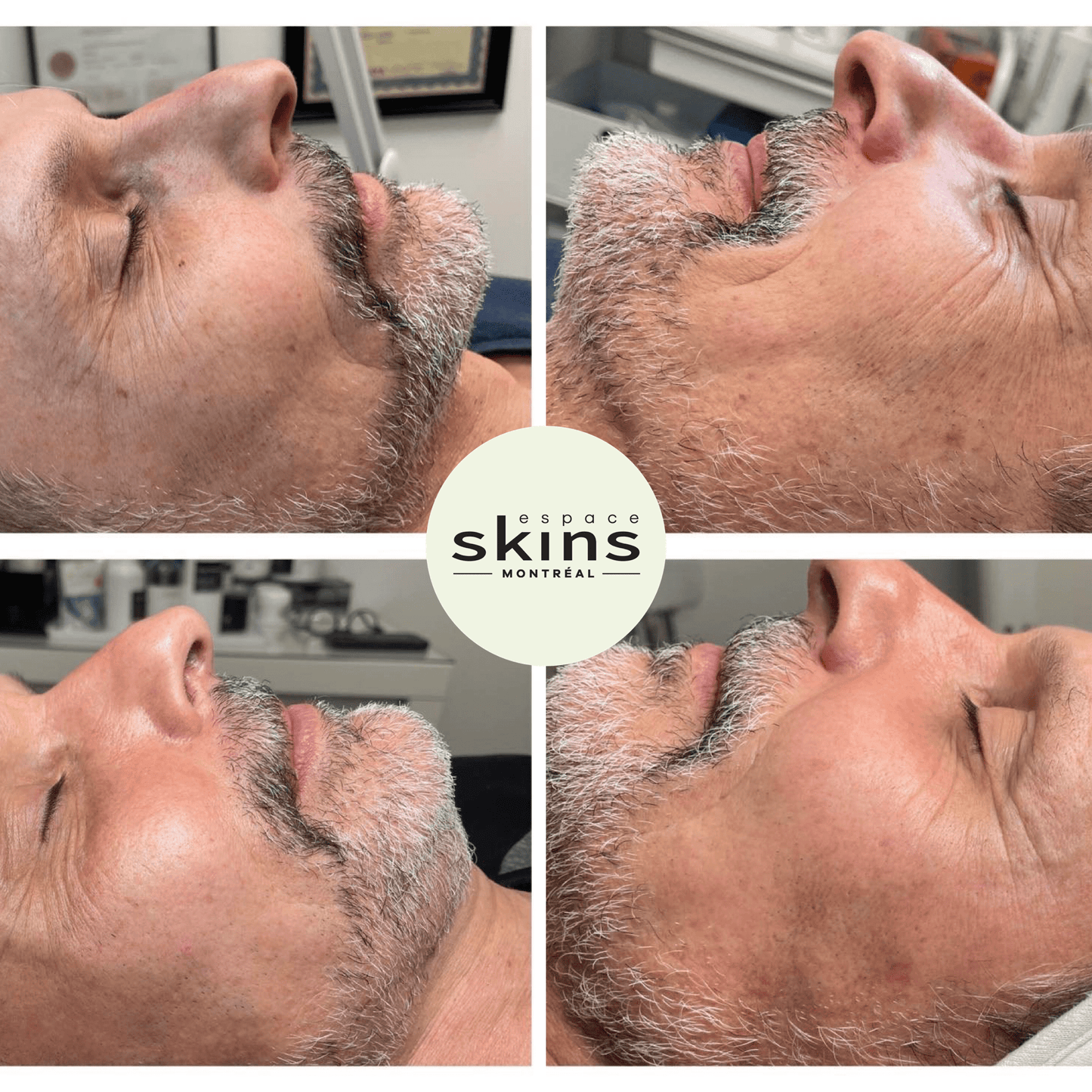 Clear & Brilliant - Fractional Laser - Espace Skins Montreal