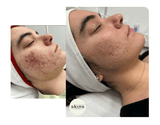 IPL Acne Treatment (Pulsed Light) - Espace Skins Montreal