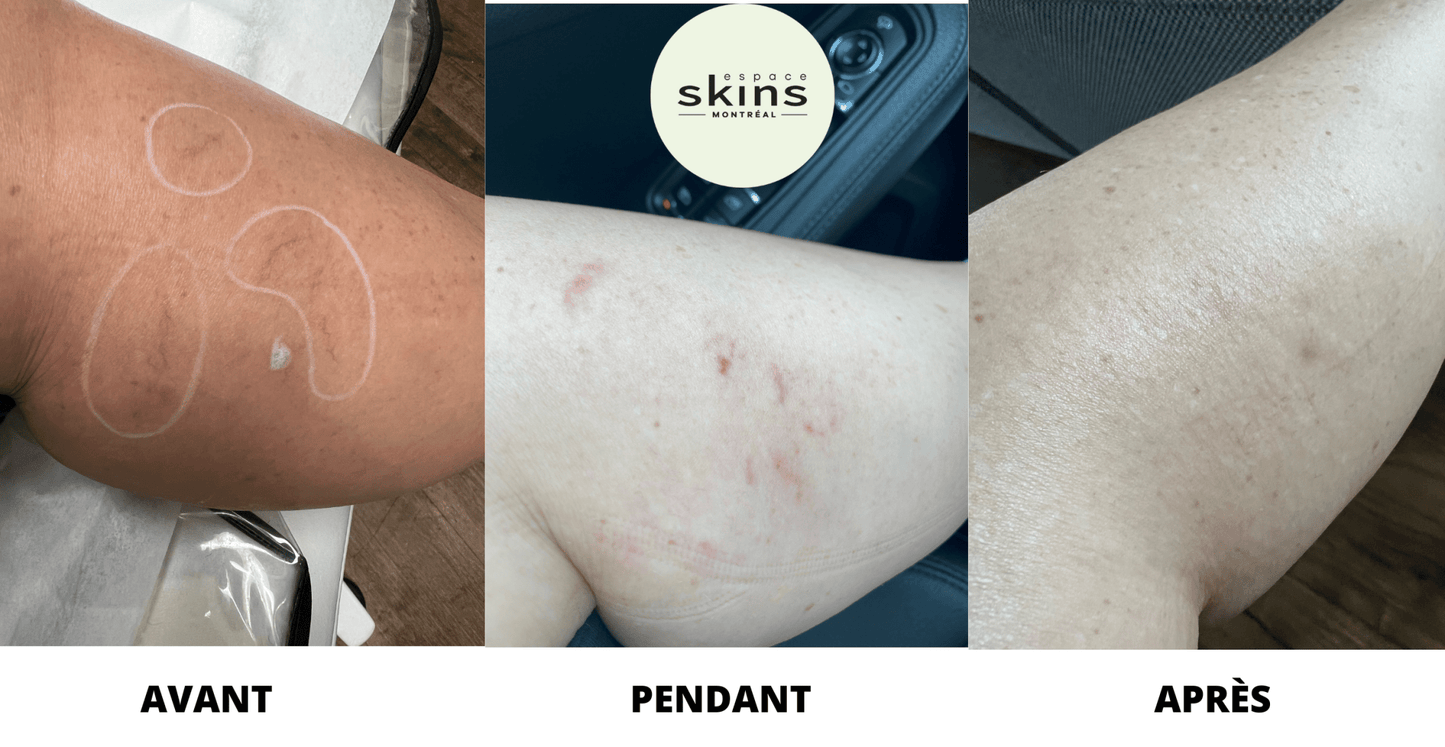 Leg Vein Removal - Espace Skins Montreal