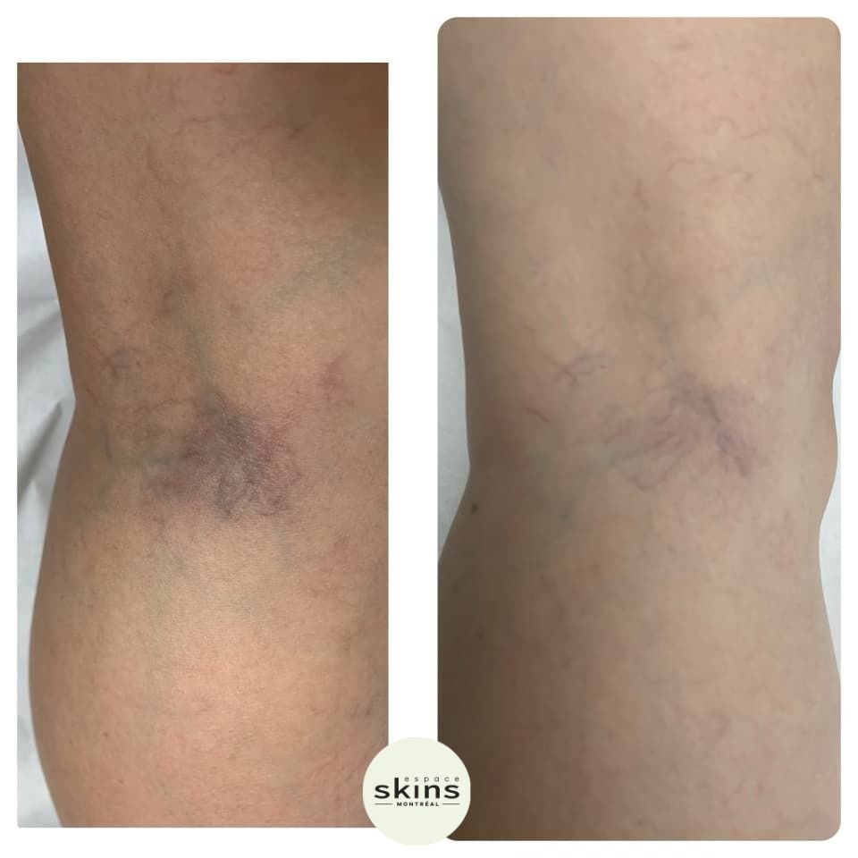 Leg Vein Removal - Espace Skins Montreal