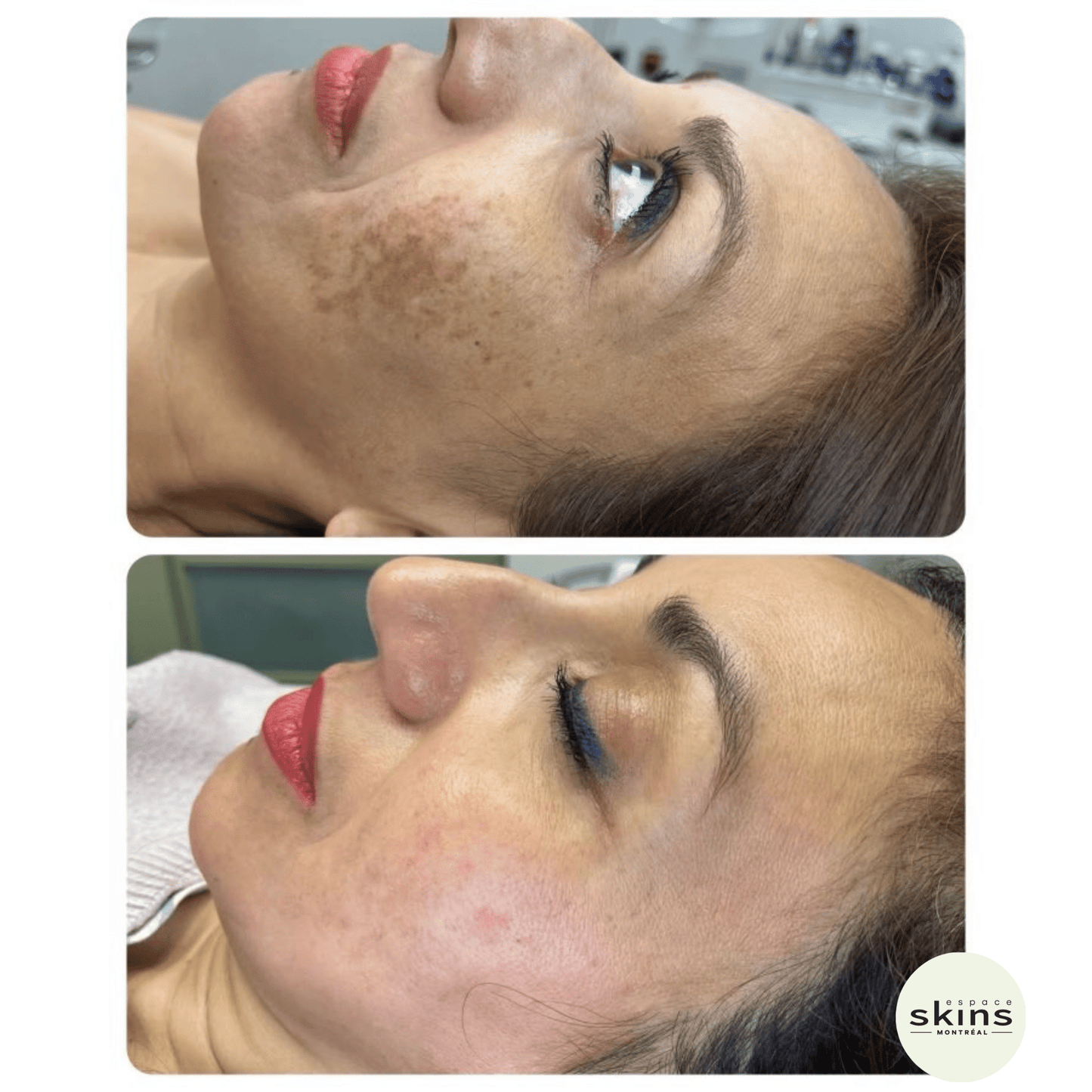 Me Line Peeling (+3 products) - Espace Skins Montreal