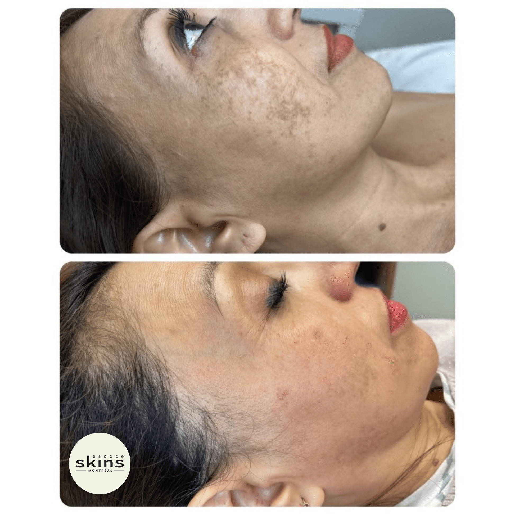 Me Line Peeling (+3 products) - Espace Skins Montreal