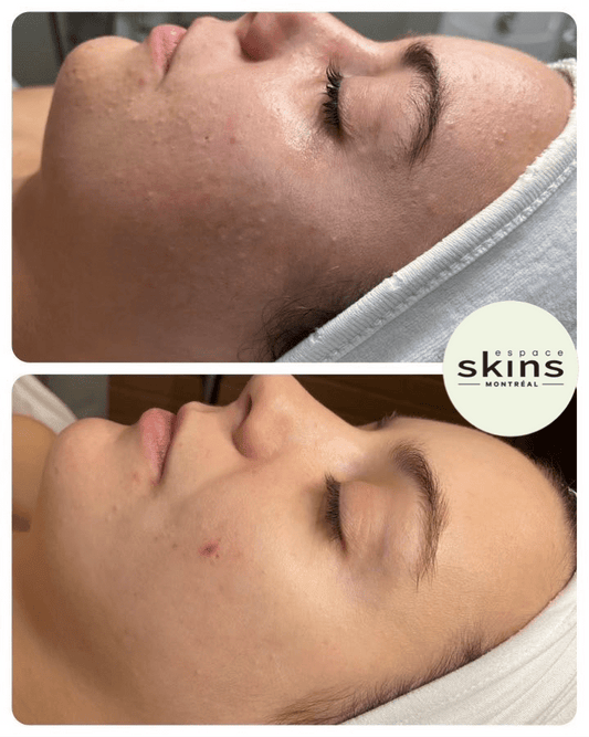 Microdermabrasion - Espace Skins Montreal