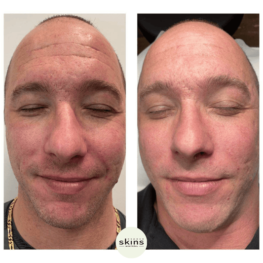 Microneedling - Espace Skins Montreal