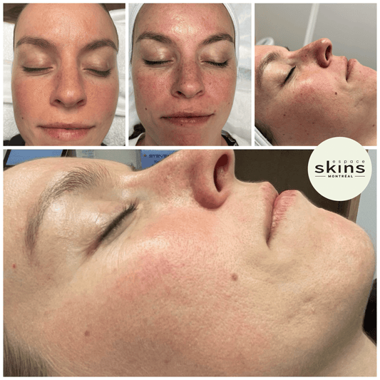 Photorejuvenation - Photofacial - Espace Skins Montreal