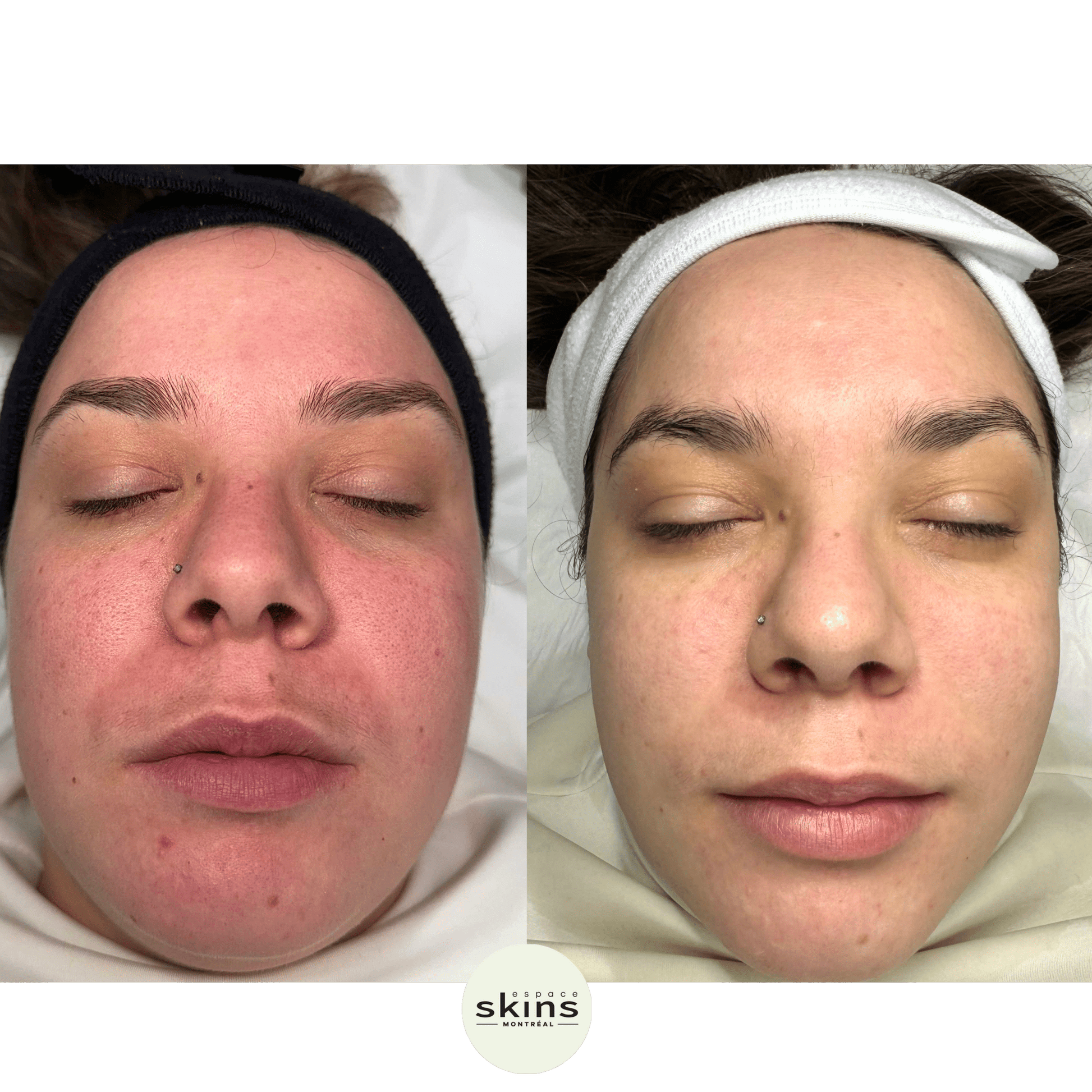 Photorejuvenation - Photofacial - Espace Skins Montreal