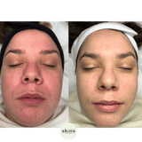 Photorejuvenation - Photofacial - Espace Skins Montreal