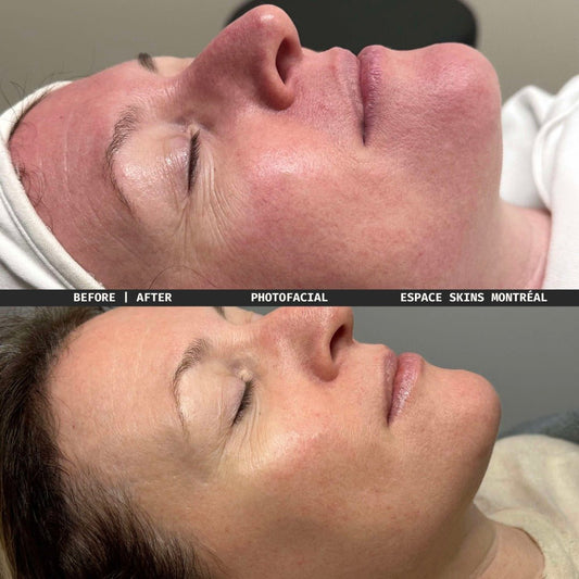 Photorejuvenation - Photofacial - Espace Skins Montreal